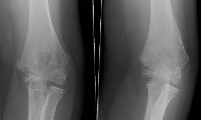 Paediatric Elbow Trochlea Avascular Necrosis